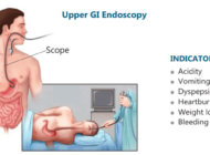 UPPER-GI-ENDOSCOPY